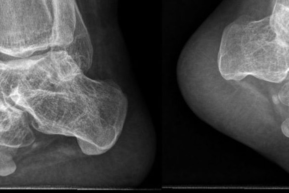 Radiografía de unos pies en 1ª posición de clásico que utiliza la directora del Centro de Danza Sandra Santa Cruz para explicar de dónde sale realmente el en dehors para no lesionarse bailando.
