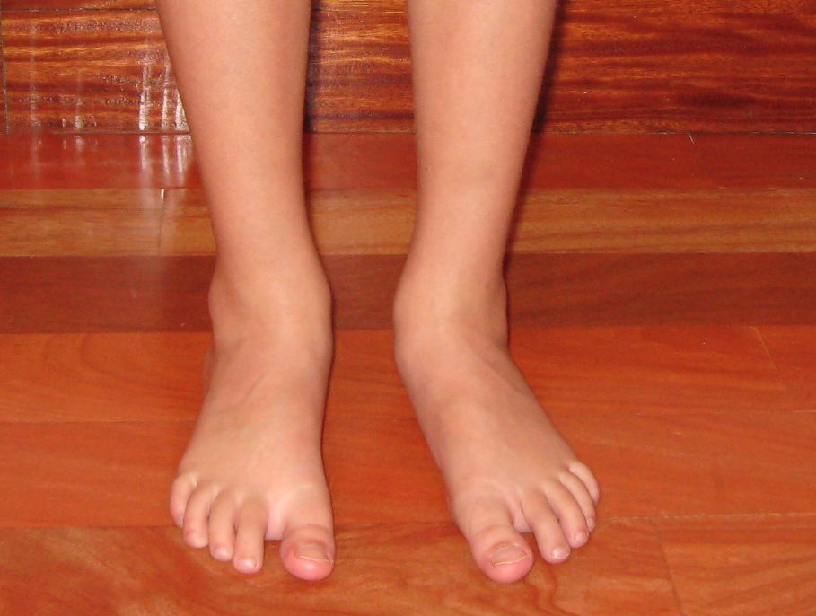 Foto de la vista anterior de unos pies plano-valgo antes del trabajo correctivo que realiza el Centro de Danza Santa Cruz.