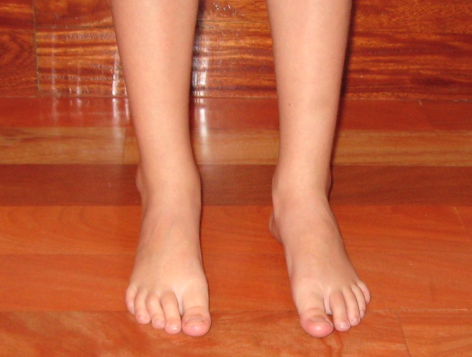 Foto de la vista anterior tras el alta médica, de unos pies plano-valgo tras varios años de trabajo correctivo que realiza el Centro de Danza Santa Cruz.