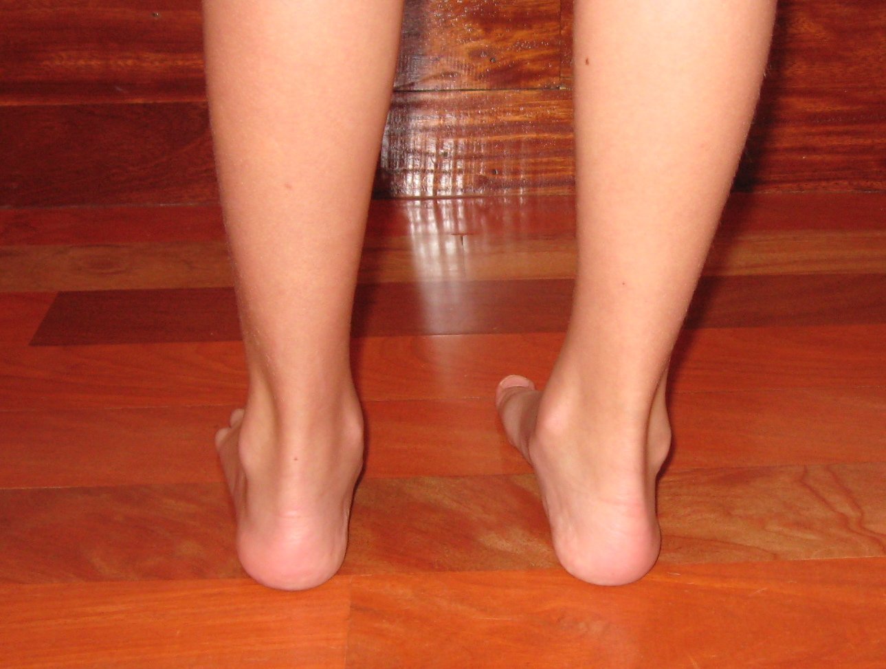 Foto de la vista posterior tras el alta médica, de unos pies plano-valgo tras varios años de trabajo correctivo que realiza el Centro de Danza Santa Cruz.