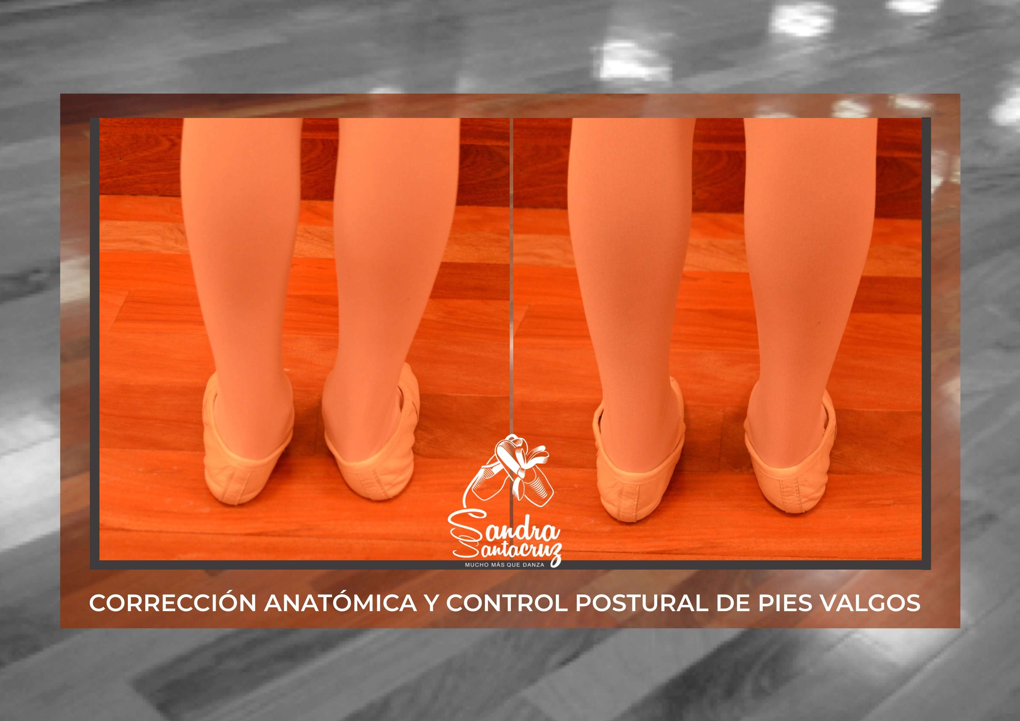 Foto de unos pies valgos de una alumna del Centro de Danza Sandra Santa Cruz del estudio que realiza la directora del Centro sobre los beneficios del ballet en la reeducación de varias patologías